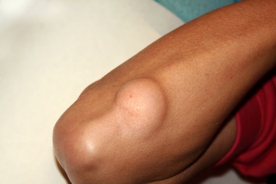 Lipoma on the elbow of the arm.